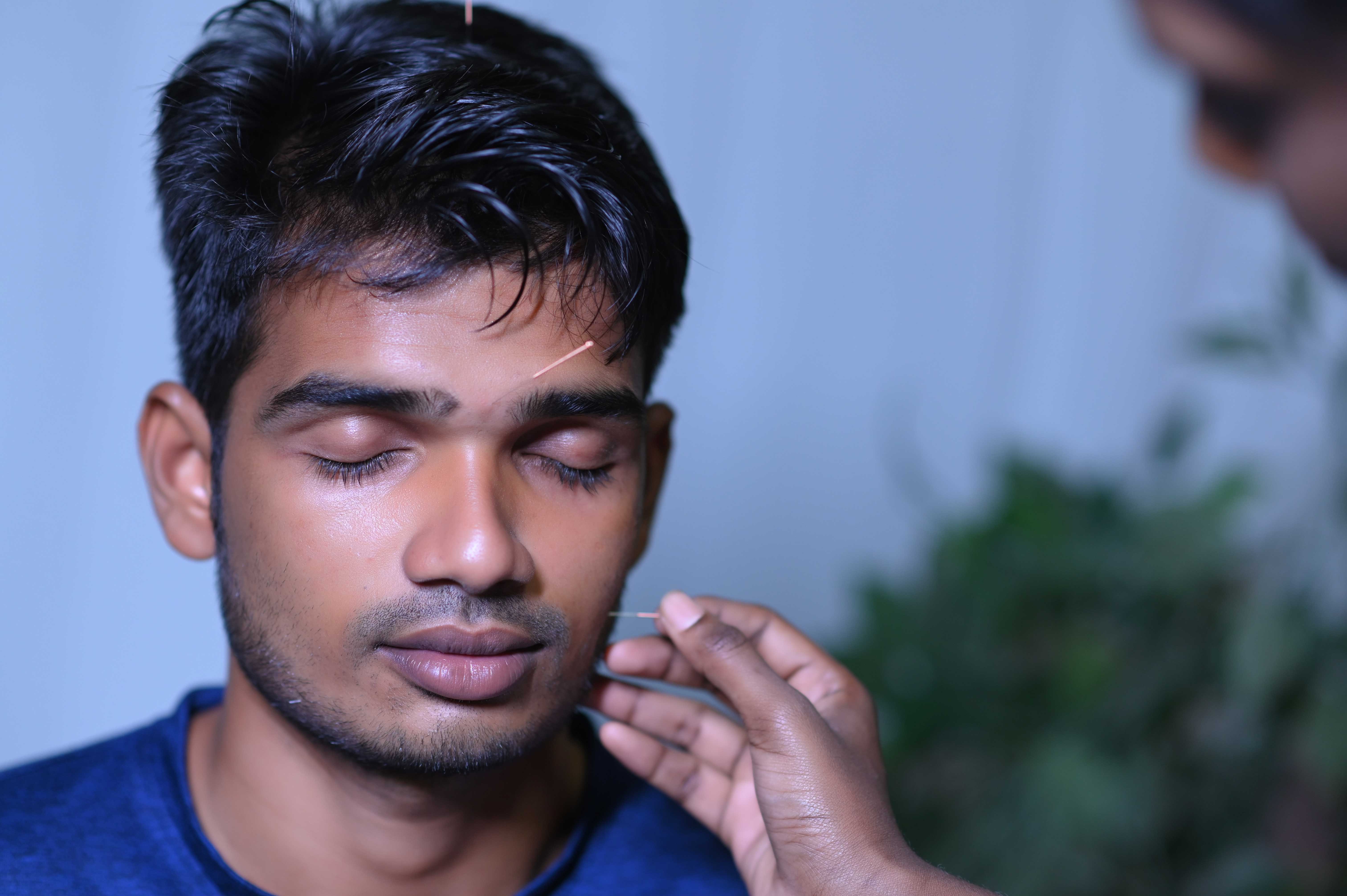 Acupuncture in face